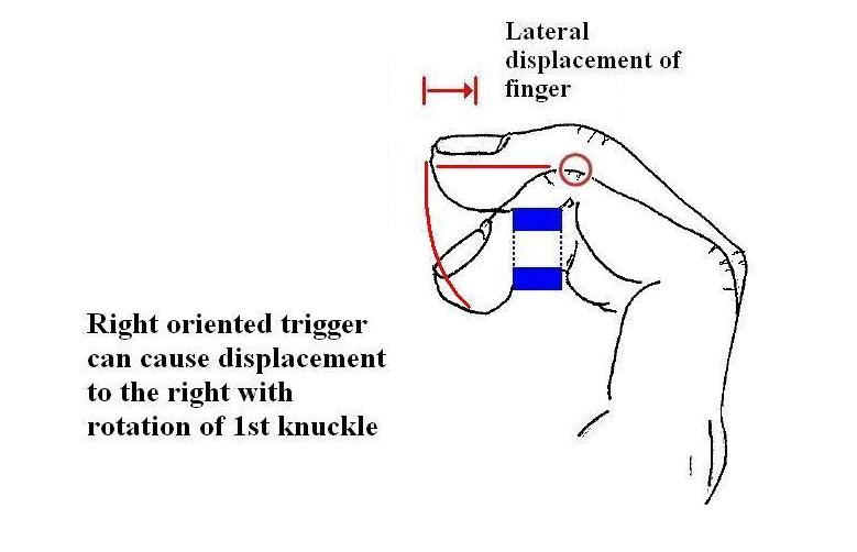 Trigger Finger Placement Chart